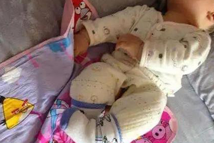 下肢肌张力增高剪刀腿图