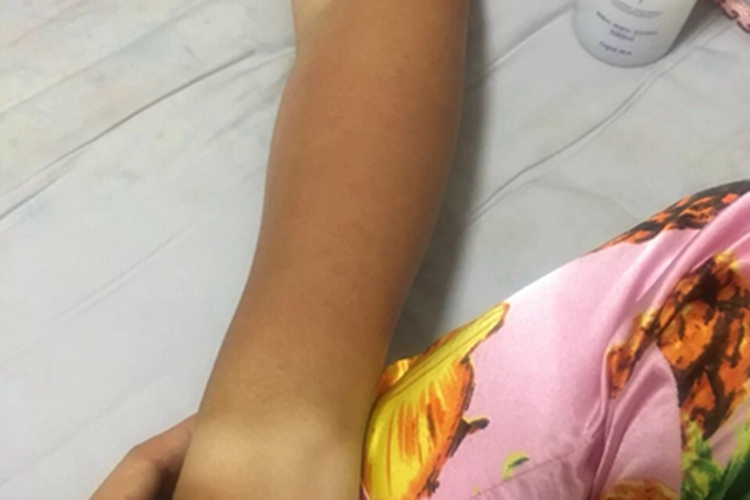 日照性皮炎皮肤颜色加深图