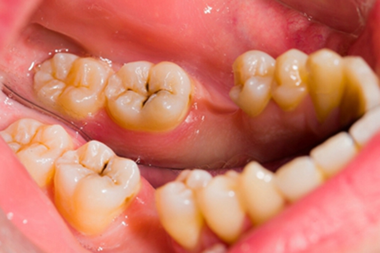 浅龋牙有黑线裂纹图 浅龋牙有黑线裂纹图