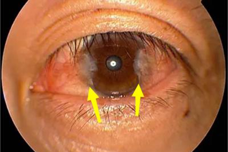 翼状胬肉眼球白斑图