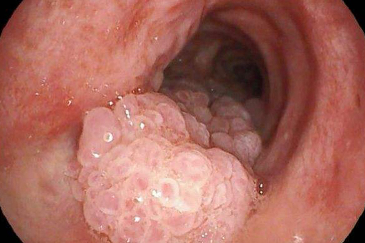 儿童喉乳头状瘤图