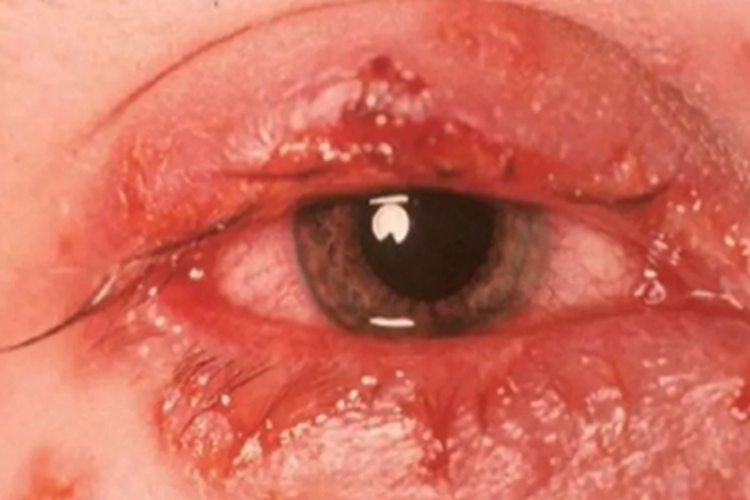 腺病毒性角结膜炎眼睑红肿图