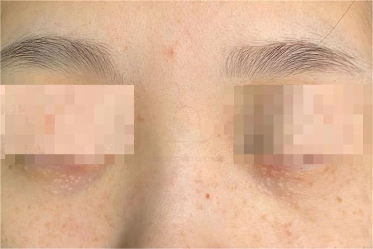 汗管瘤图 汗管瘤图