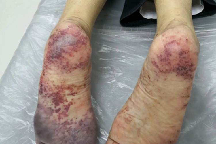 静脉曲张性溃疡脚底血点图