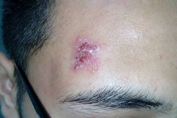 单纯疱疹前额潮红水疱结痂图