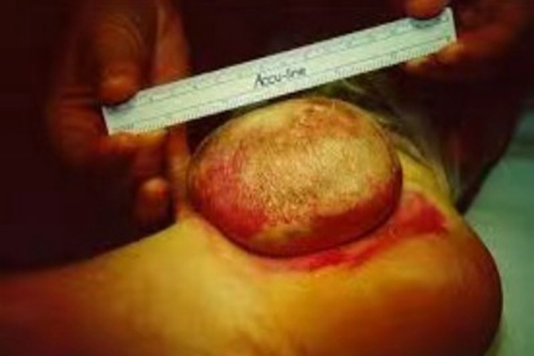 透明细胞汗腺瘤脚部有包块图