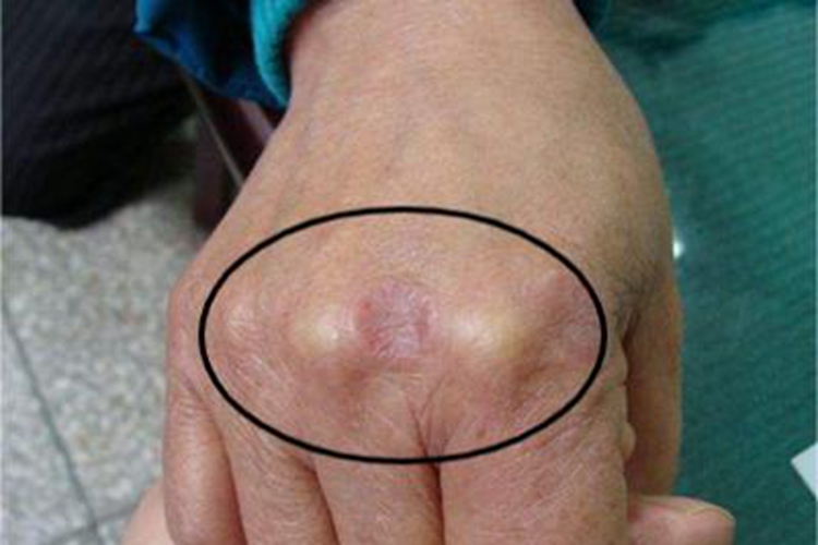 皮下型环状肉芽肿手背症状图
