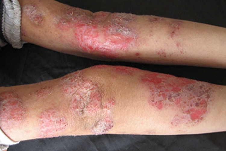 儿童期特应性皮炎糜烂图 儿童期特应性皮炎糜烂图