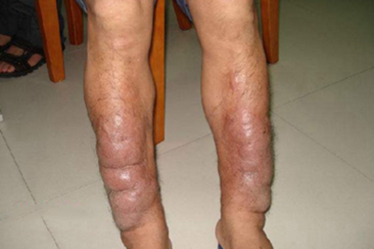 黏液性水肿小腿症状图