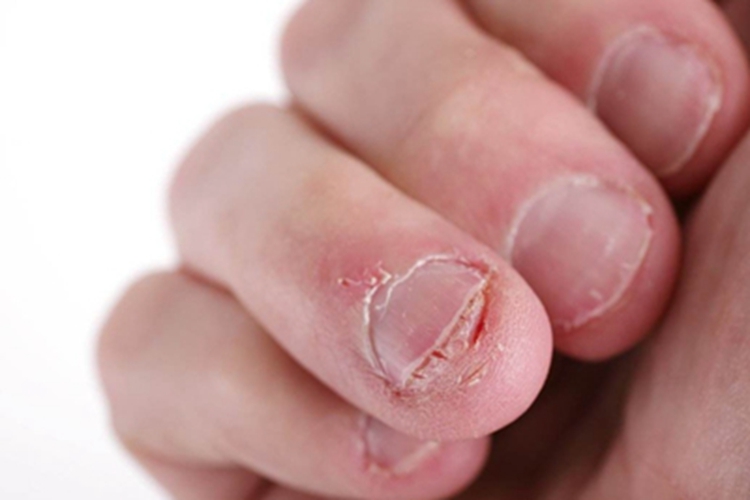 咬甲癖手指甲缺损图