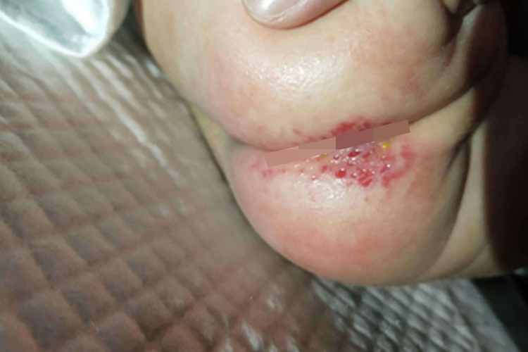 脓疱病臀部渗液图 脓疱病臀部渗液图