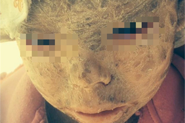 鱼鳞病面部结痂图