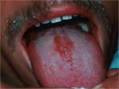 正中菱形舌炎舌头中间有红斑图.png