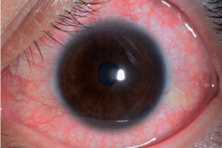 罗阿丝虫病结膜充血图