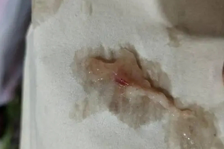 咽炎痰中有褐色絮状物图