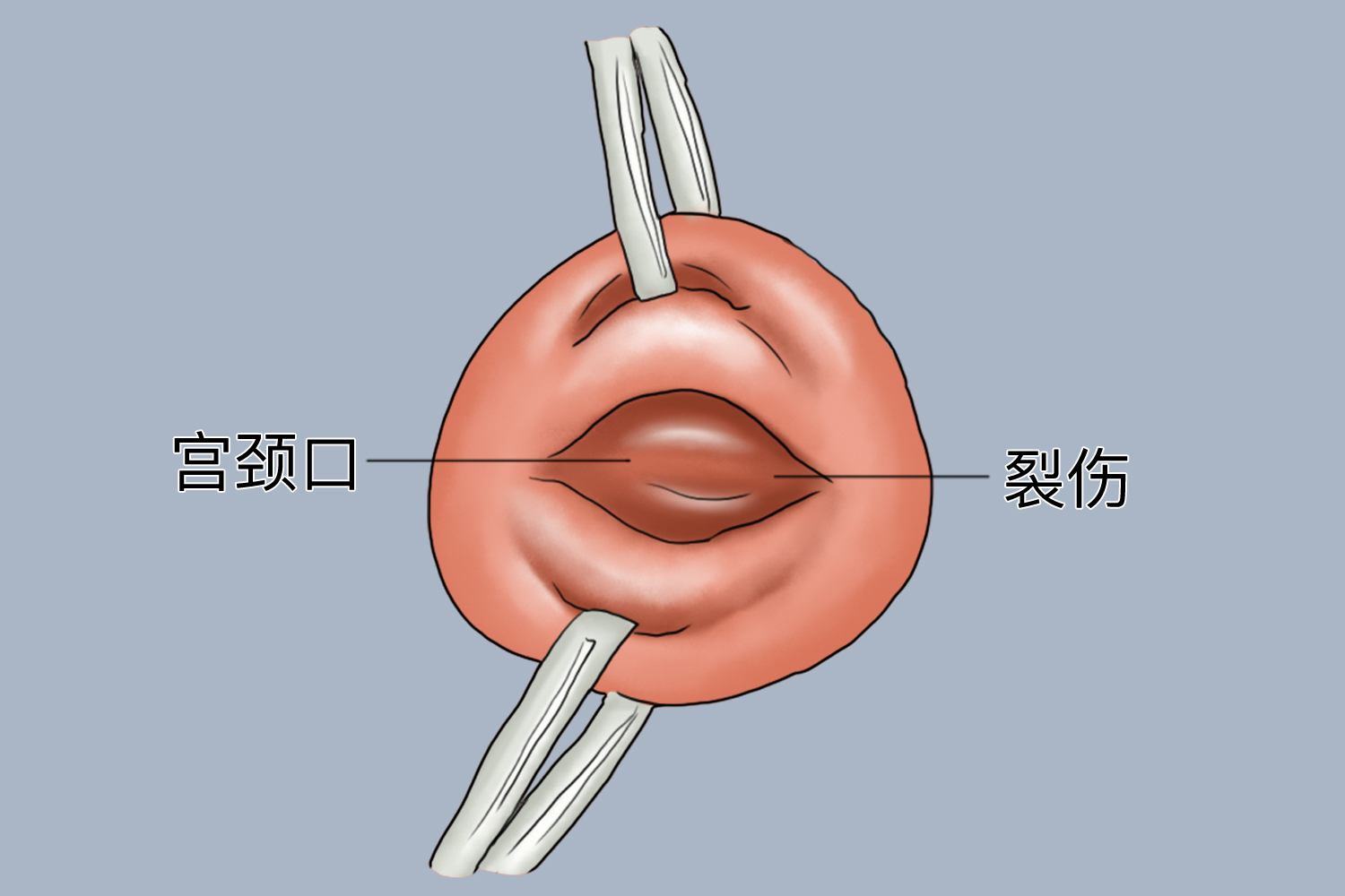 宫颈图片外翻图片