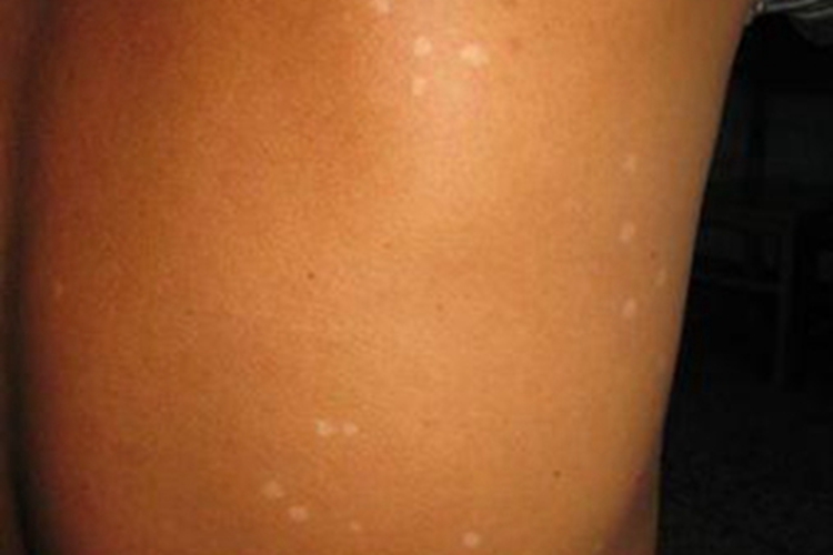 特发性点状色素减退斑背部症状图