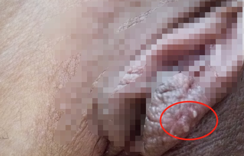 女性生殖器疱疹的图片