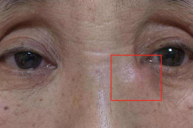 眼角处良性泪囊肿瘤图