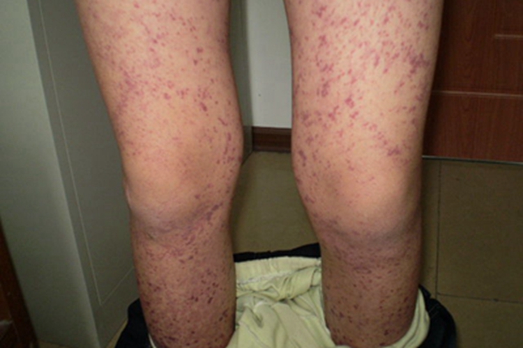 单纯性紫癜腿紫斑图