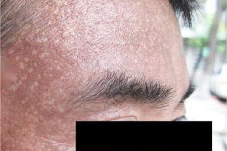 焦油黑变病前额症状图