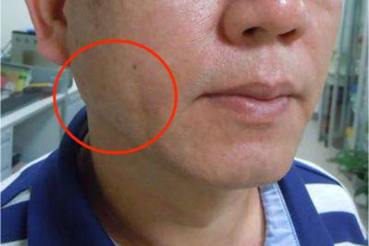 慢性阻塞性腮腺炎面部轻微肿大图