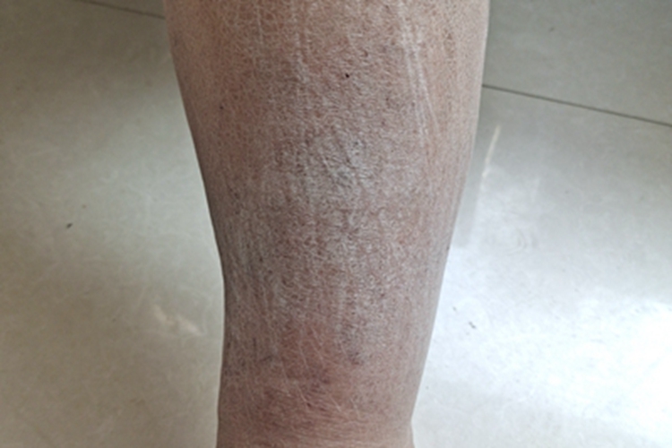 慢性湿疹皮肤增厚图 慢性湿疹皮肤增厚图