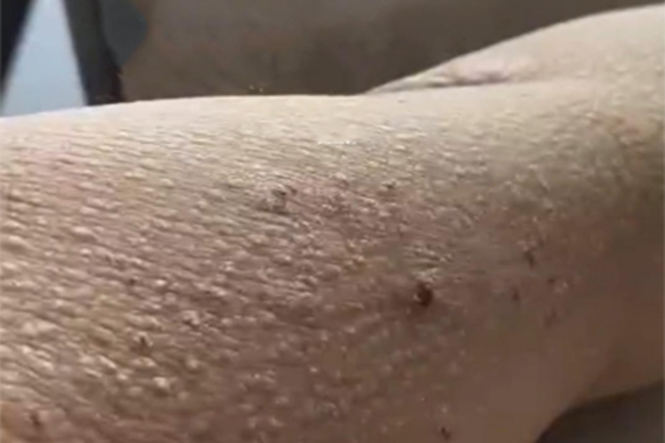 继发性皮肤淀粉样变胳膊脱屑图 继发性皮肤淀粉样变胳膊脱屑图