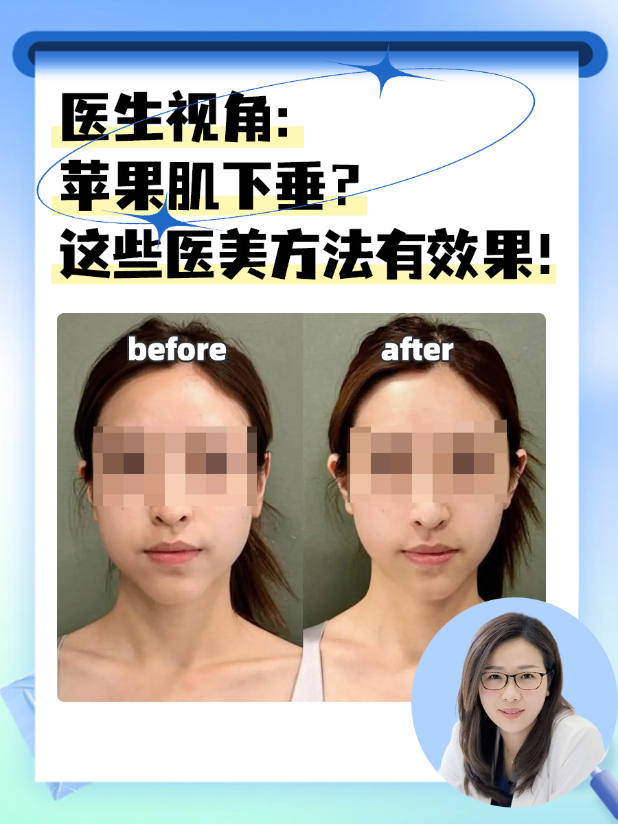 医生视角：苹果肌下垂？这些医美方法有效果！