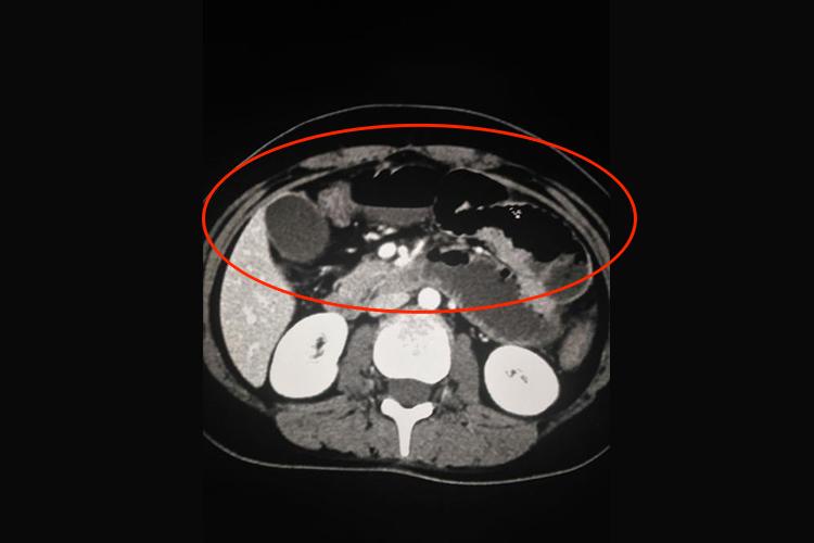 粘连性肠梗阻CT图