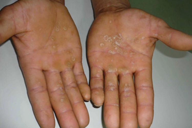 三期梅毒手掌圆形脱皮图