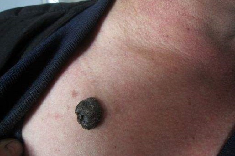 黑素瘤胸部疙瘩图