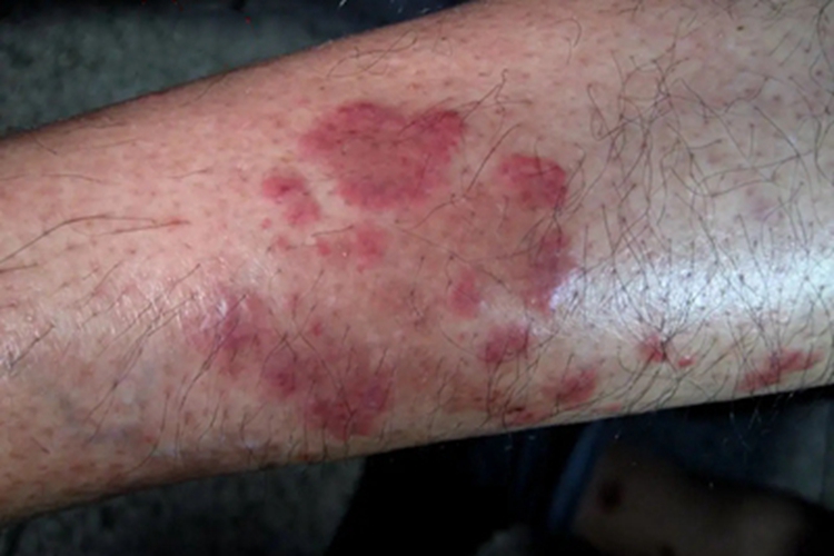 变应性皮肤血管炎结节图