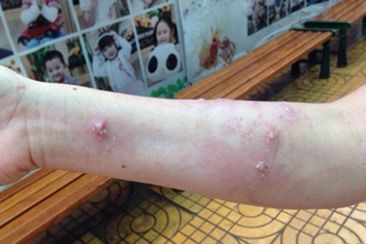 红蚂蚁咬完后的疙瘩图