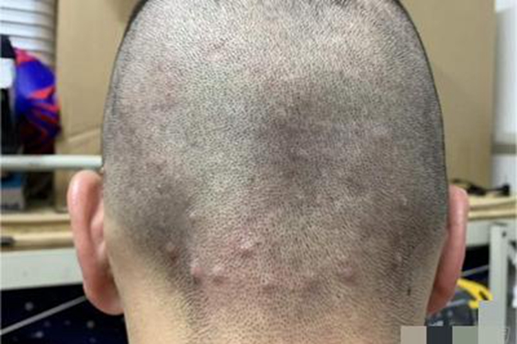 毛囊炎头皮丘疹图 毛囊炎头皮丘疹图