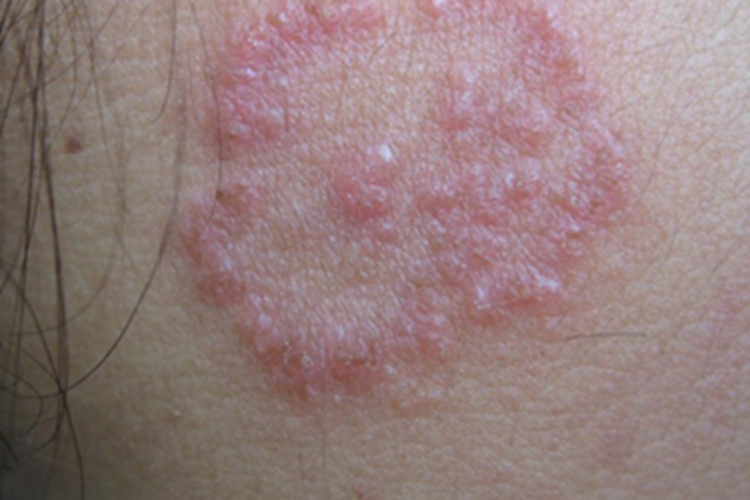 单纯性回状红斑丘疹图