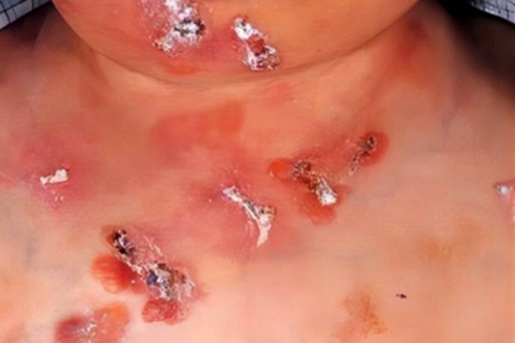 脓窝疮胸部结痂图 脓窝疮胸部结痂图