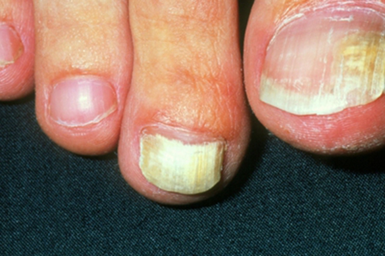 甲真菌病脚趾甲竖纹图