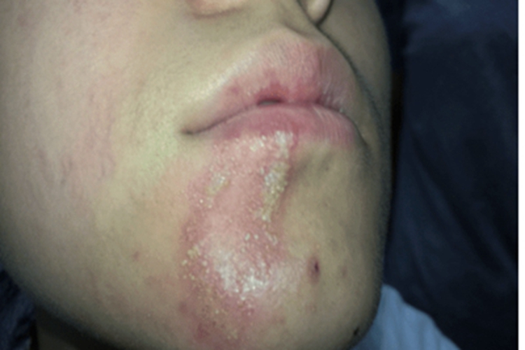 隐翅虫皮炎红斑脓疱图 隐翅虫皮炎红斑脓疱图