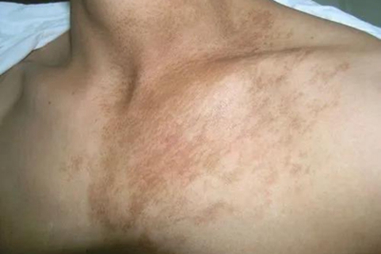 色素性毛表皮痣胸部症状图