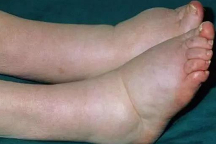 旋毛虫病双脚水肿图