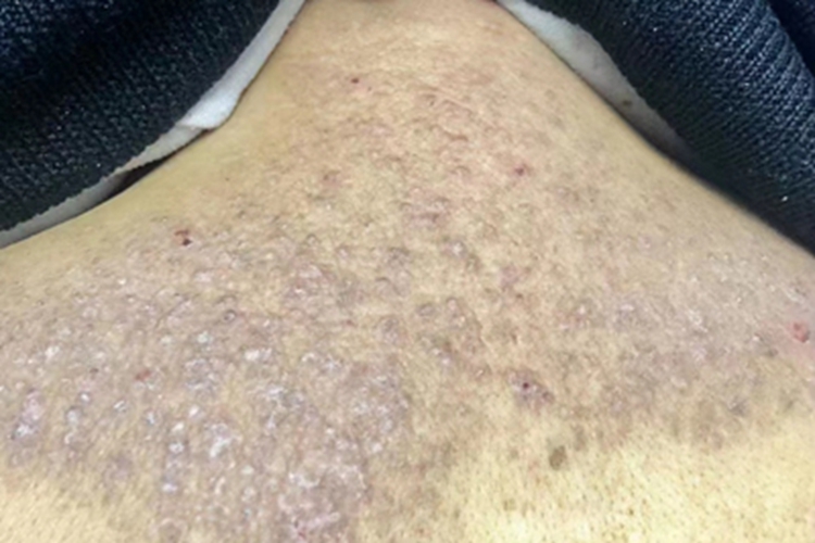 继发性皮肤淀粉样变背上有疙瘩图