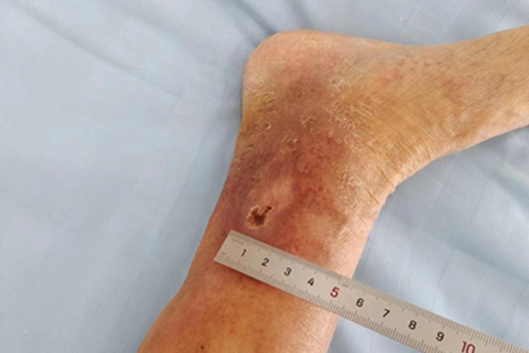 臁疮小腿有一小块结痂图