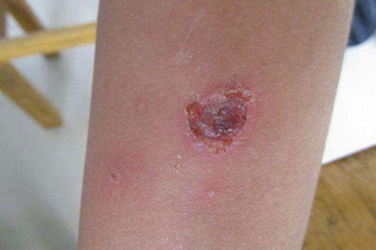 深脓疱疮胳膊溃疡图