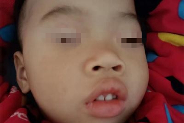 腺样体肥大面部症状图 腺样体肥大面部症状图