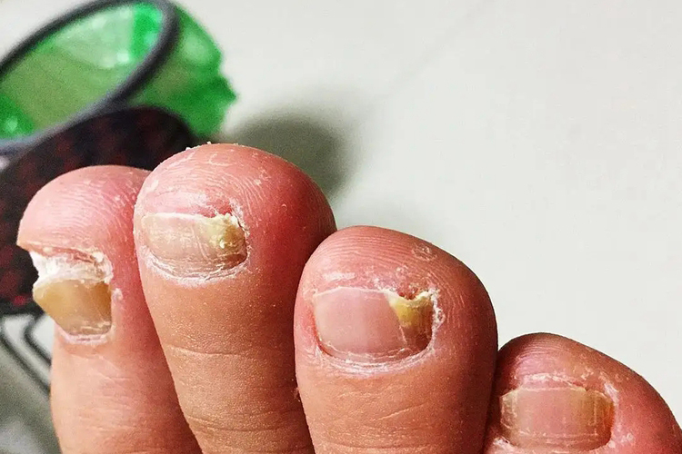 远端侧位甲下型灰指甲图