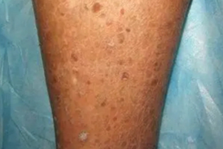 灰泥角化病长斑图