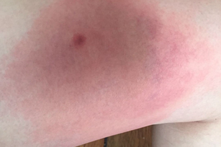 蜘蛛蜇伤大腿红肿图