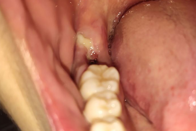 上皮组织向血块表面增殖图