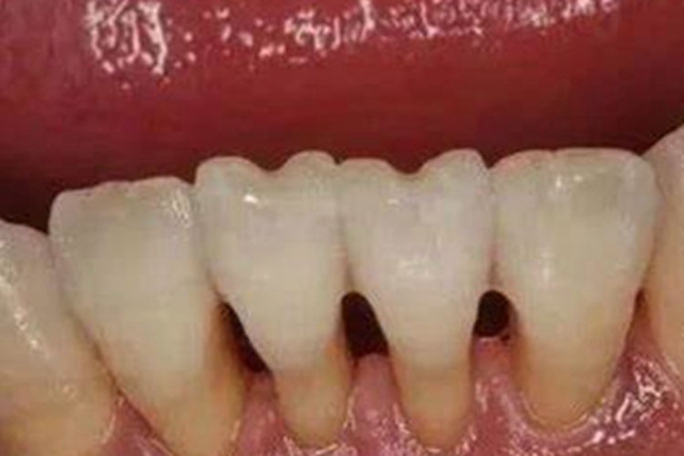 牙龈退缩露出黄褐色牙根图